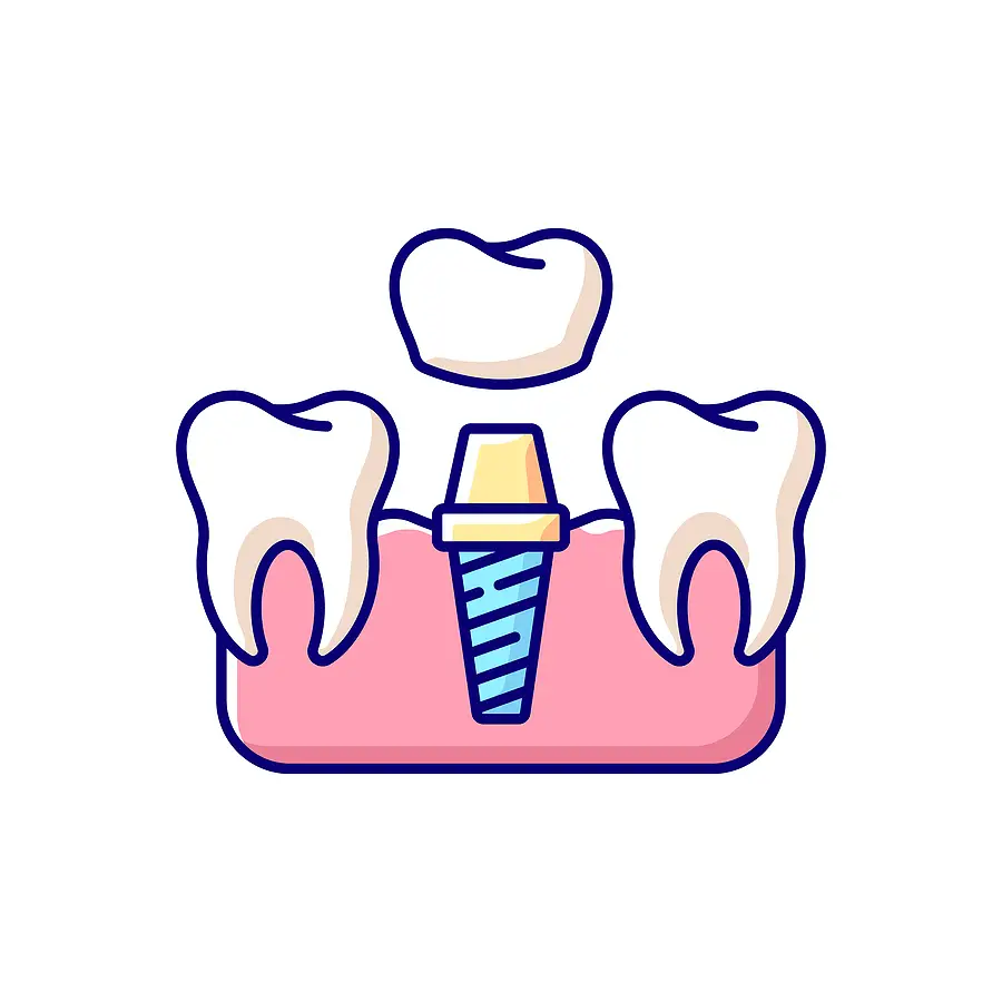 Dental Implants Dental Implants